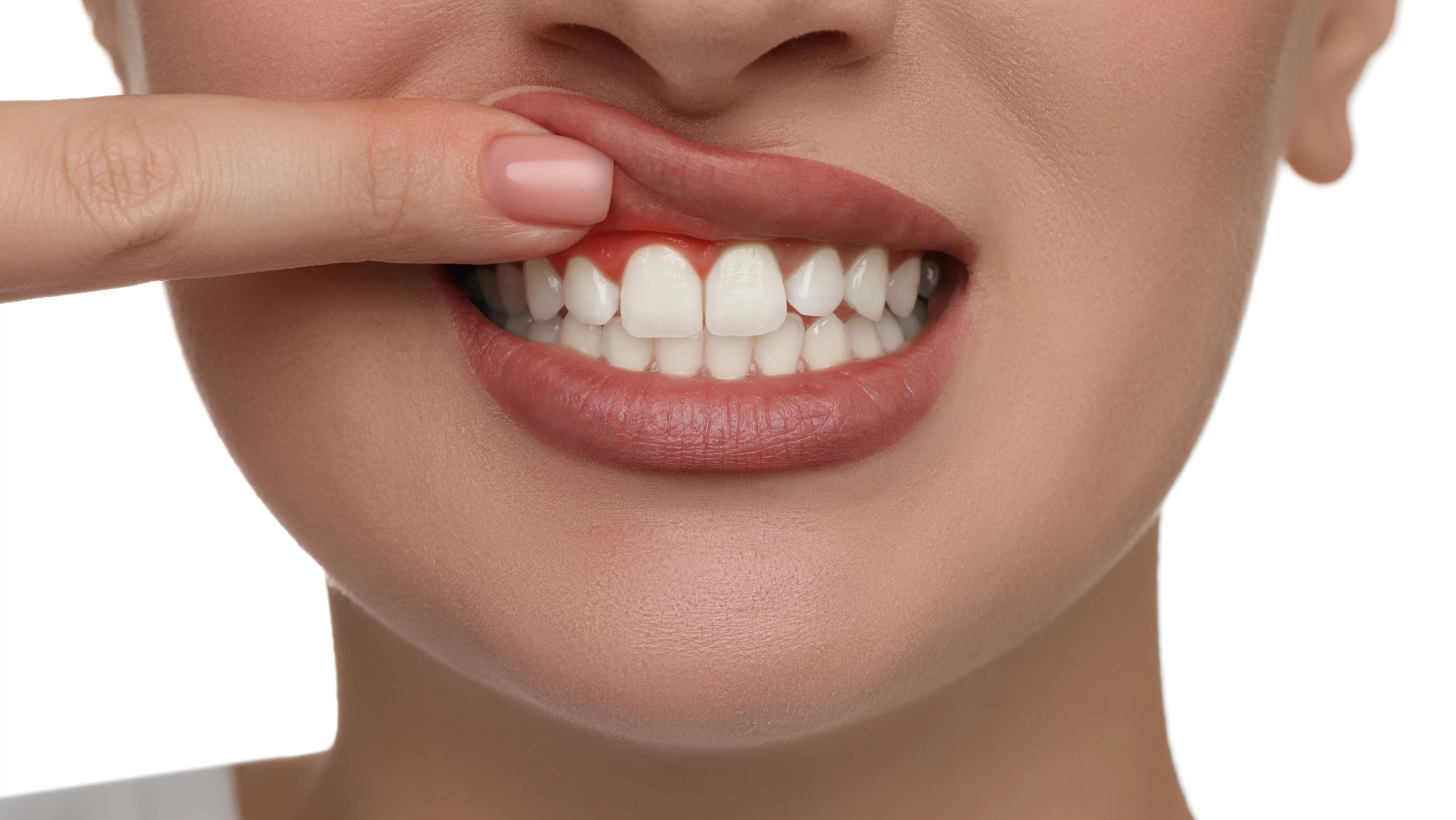 Diş Eti Estetiği ve İyileşme Süreci: Detaylı Rehber
