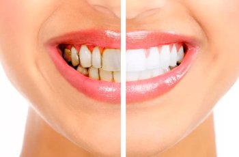 Diş lekeleri neden oluşur? nasıl temizlenir?