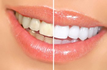 Diş Teli  Kaç Yaşında Takılır? En Erken ve En Geç Yaş Sınırları