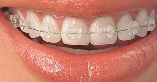 Diş Teli Nedir? Nasıl Takılır?