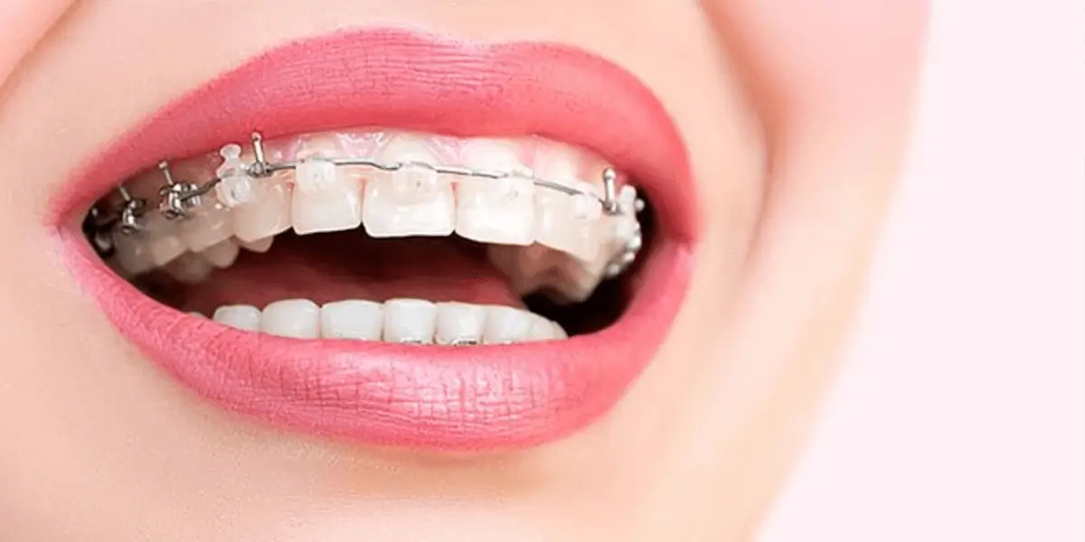 Diş Teli Taktırmanın Faydaları Zararları Nelerdir?