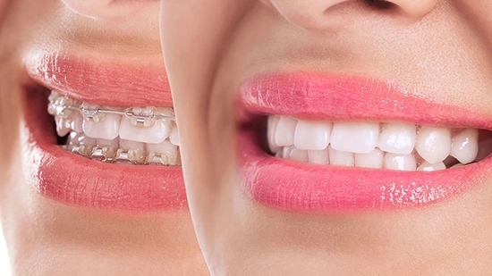 Diş Teli Tedavisi Aşamaları Öncesi Sonrası
