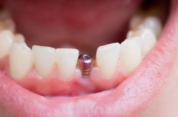 implant diş nasıl yapılır? 