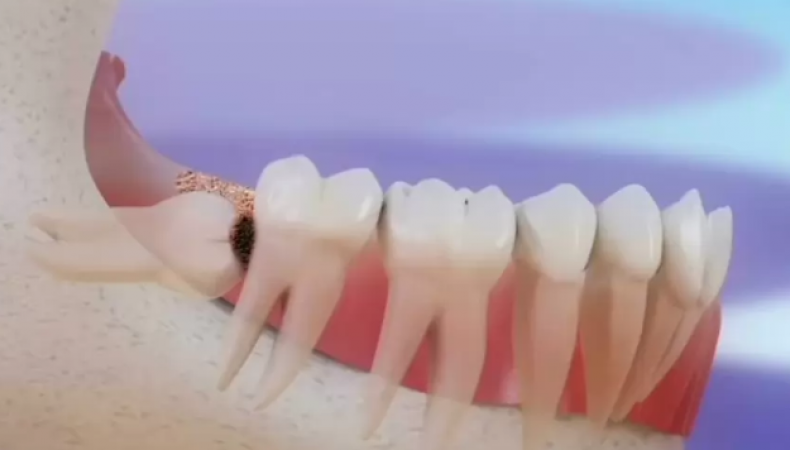 20'lik diş ağrısı ve belirtileri nelerdir?