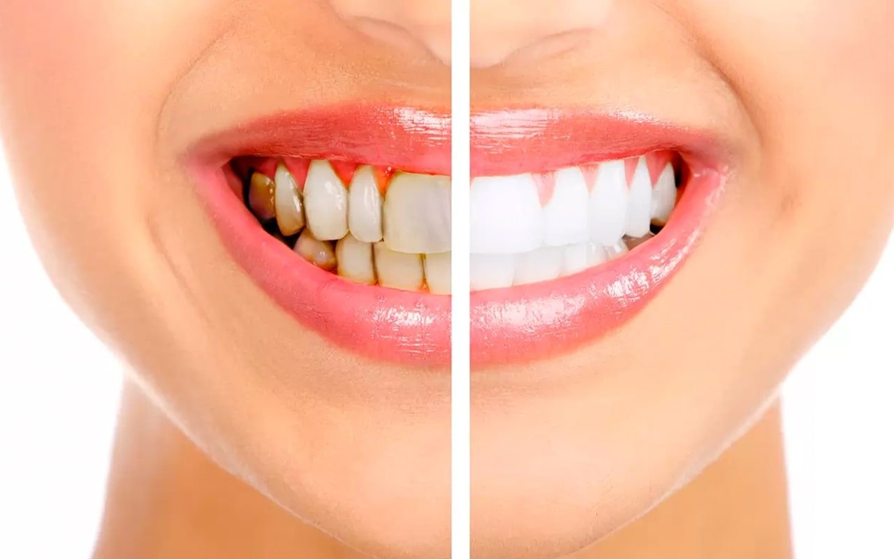 Diş lekeleri neden oluşur? nasıl temizlenir?