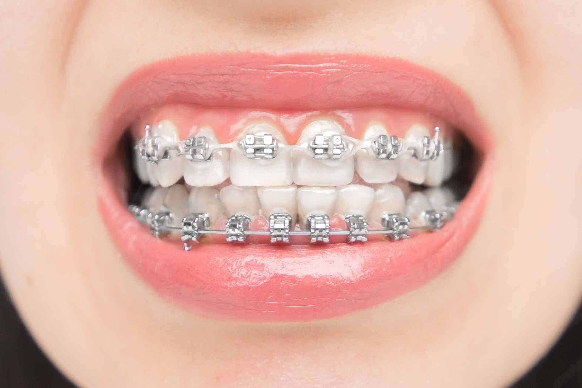 Diş teli lastiği nedir? neden takılır? ne kadar kullanılır?