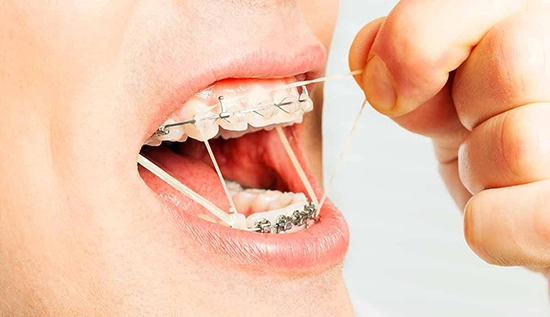Diş Teli Tedavisi Ne Kadar Sürer?