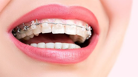 Diş teli tedavisi ortodonti