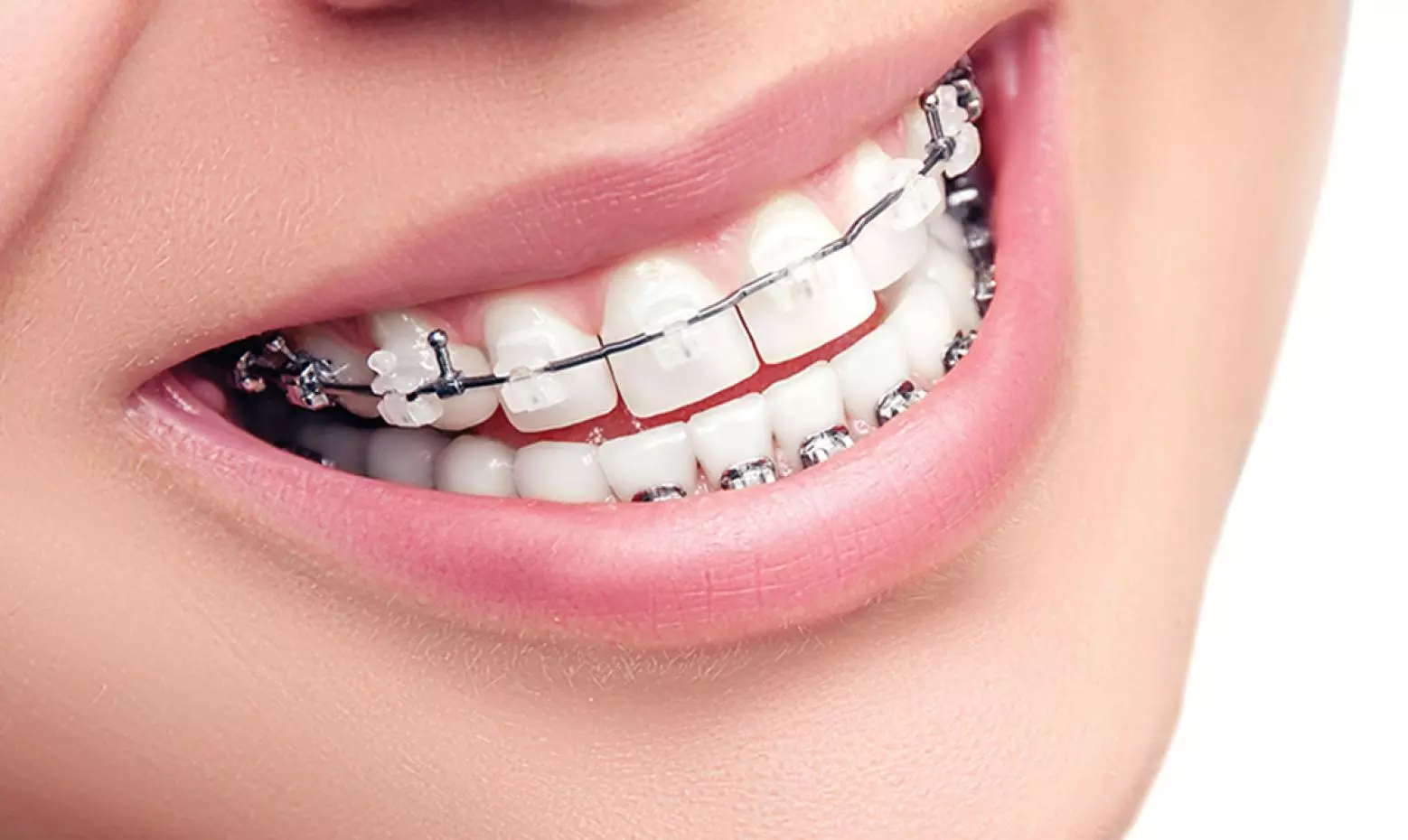 Diş Teli Tedavisine Ne Zaman Başlanmalı? Yaşa Göre Tedavi Planlaması
