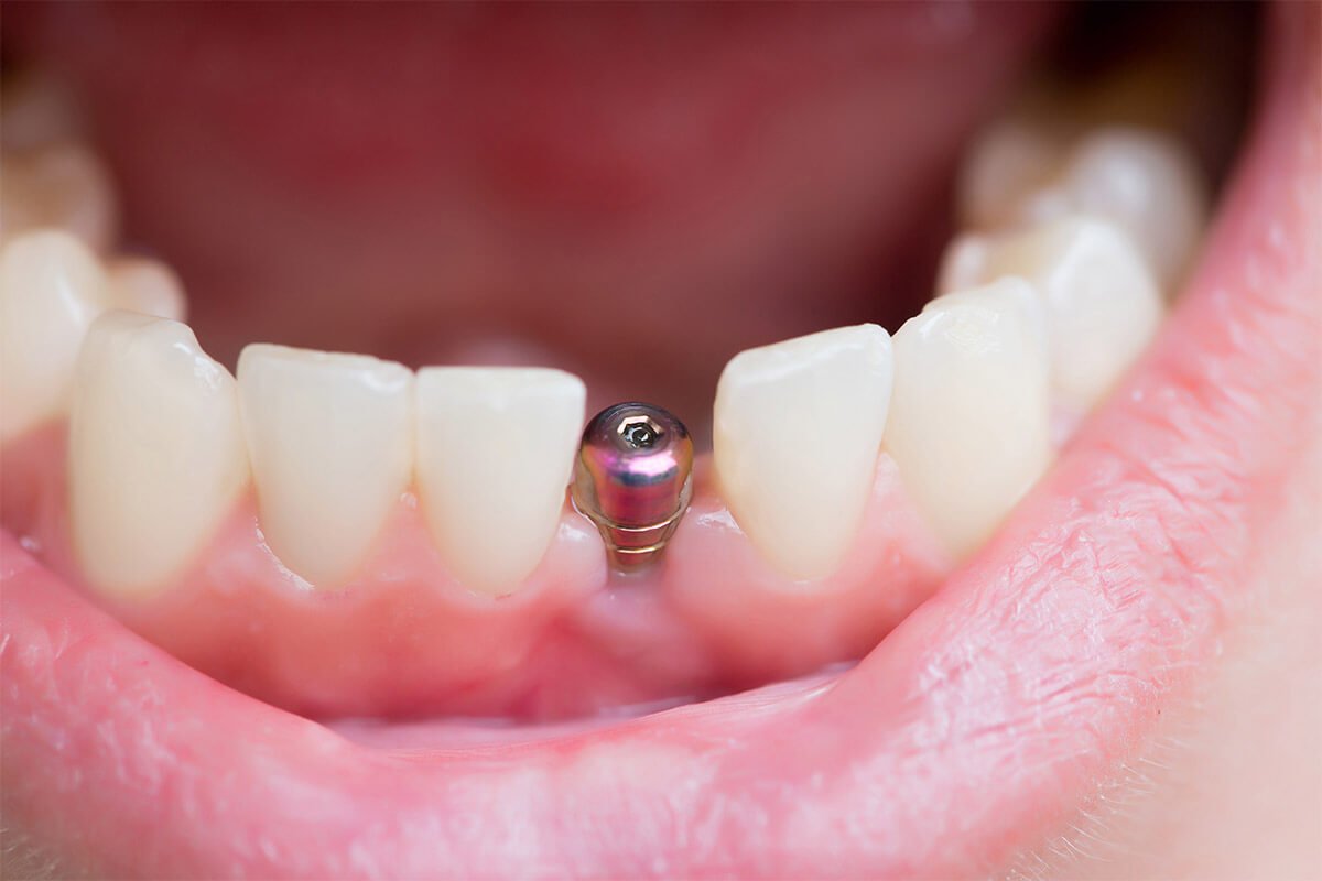 implant diş nasıl yapılır? 
