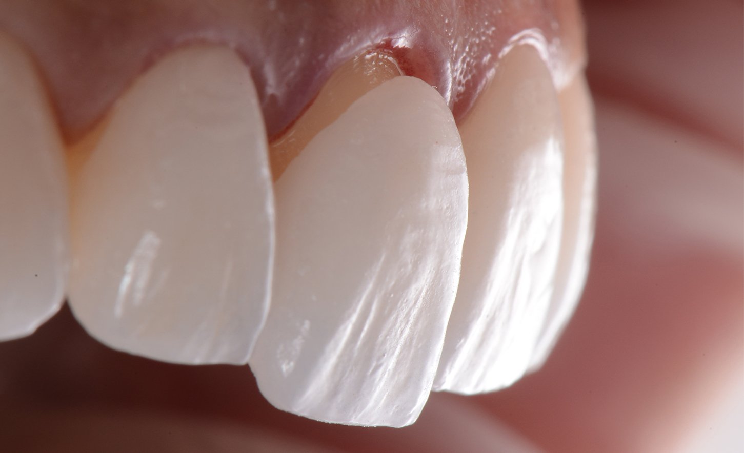 Laminate Veneer Diş Kaplamaları: Mükemmel Gülüşün Sırrı